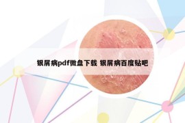 銀屑病pdf微盤下載 銀屑病百度貼吧