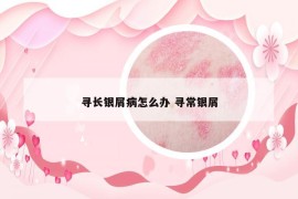 尋長(zhǎng)銀屑病怎么辦 尋常銀屑