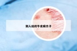 別人給的牛皮癬方子