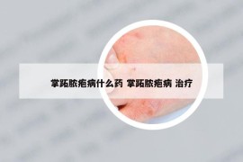 掌跖膿皰病什么藥 掌跖膿皰病 治療