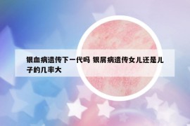 銀血病遺傳下一代嗎 銀屑病遺傳女兒還是兒子的幾率大