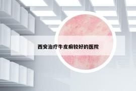西安治療牛皮癬較好的醫(yī)院