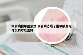 銀屑病指甲蓋潰爛 銀屑病造成了指甲病變吃什么藥可以治好