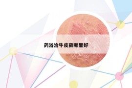 藥浴治牛皮蘚哪里好