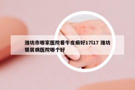 濰坊市哪家醫(yī)院看牛皮癬好17l17 濰坊銀屑病醫(yī)院哪個好