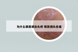 為什么銀屑病會頭疼 銀屑病頭皮痛