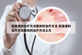蛇盤瘡的治療方法最快的治療方法 蛇盤瘡的治療方法最快的治療方法土方