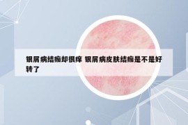 銀屑病結(jié)痂卻很癢 銀屑病皮膚結(jié)痂是不是好轉(zhuǎn)了