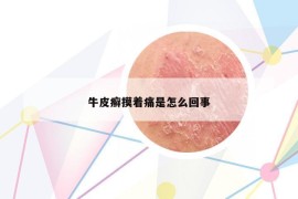 牛皮癬摸著痛是怎么回事