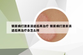 銀屑病打激素消退后再治療 銀屑病打激素消退后再治療會(huì)怎么樣