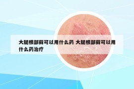 大腿根部蘚可以用什么藥 大腿根部蘚可以用什么藥治療