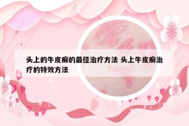 頭上的牛皮癬的最佳治療方法 頭上牛皮癬治療的特效方法