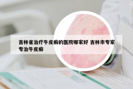 吉林省治療牛皮癬的醫(yī)院哪家好 吉林市專家專治牛皮癬