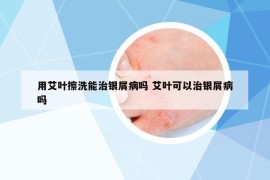 用艾葉擦洗能治銀屑病嗎 艾葉可以治銀屑病嗎