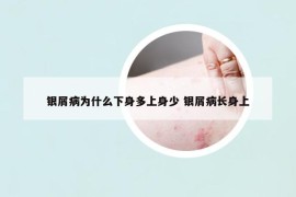 銀屑病為什么下身多上身少 銀屑病長身上