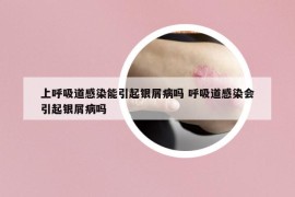 上呼吸道感染能引起銀屑病嗎 呼吸道感染會引起銀屑病嗎