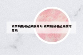 銀屑病能引起尿酸高嗎 銀屑病會(huì)引起尿酸增高嗎