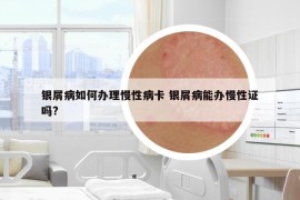 銀屑病如何辦理慢性病卡 銀屑病能辦慢性證嗎?