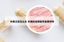長癬之后怎么辦 長癬的皮膚能恢復(fù)原樣嗎