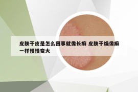 皮膚干皮是怎么回事就像長癬 皮膚干燥像癬一樣慢慢變大