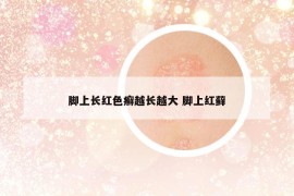 腳上長紅色癬越長越大 腳上紅蘚