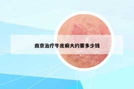 南京治療牛皮癬大約要多少錢