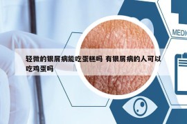 輕微的銀屑病能吃蛋糕嗎 有銀屑病的人可以吃雞蛋嗎