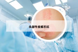 頭部牛皮癬不紅