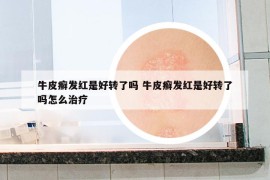 牛皮癬發(fā)紅是好轉(zhuǎn)了嗎 牛皮癬發(fā)紅是好轉(zhuǎn)了嗎怎么治療