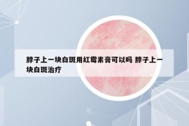 脖子上一塊白斑用紅霉素膏可以嗎 脖子上一塊白斑治療