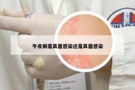 牛皮癬是真菌感染還是真菌感染