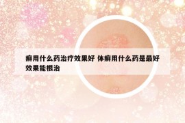 癬用什么藥治療效果好 體癬用什么藥是最好效果能根治