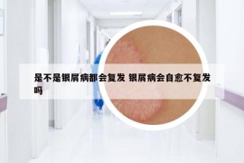 是不是銀屑病都會(huì)復(fù)發(fā) 銀屑病會(huì)自愈不復(fù)發(fā)嗎