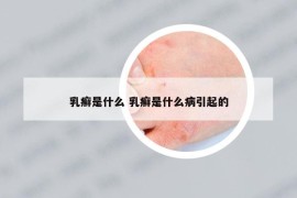 乳癬是什么 乳癬是什么病引起的