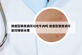 膿皰型銀屑病可以吃牛肉嗎 膿皰型銀屑病不能吃哪些水果