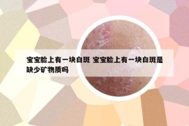 寶寶臉上有一塊白斑 寶寶臉上有一塊白斑是缺少礦物質(zhì)嗎