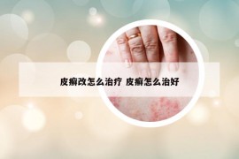 皮癬改怎么治療 皮癬怎么治好