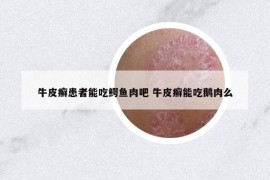 牛皮癬患者能吃鱷魚肉吧 牛皮癬能吃鵝肉么