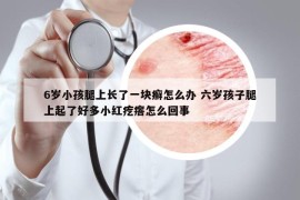 6歲小孩腿上長(zhǎng)了一塊癬怎么辦 六歲孩子腿上起了好多小紅疙瘩怎么回事