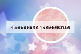 牛皮癬會(huì)長(zhǎng)到肛周嗎 牛皮癬會(huì)長(zhǎng)到肛門(mén)上嗎