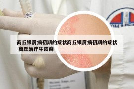 商丘銀屑病初期的癥狀商丘銀屑病初期的癥狀 商丘治療牛皮癬