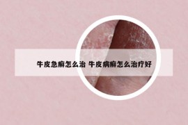 牛皮急癬怎么治 牛皮病癬怎么治療好