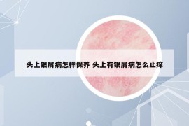 頭上銀屑病怎樣保養(yǎng) 頭上有銀屑病怎么止癢
