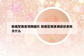 膿皰型銀屑初期圖片 膿皰型銀屑病癥狀表現(xiàn)分什么