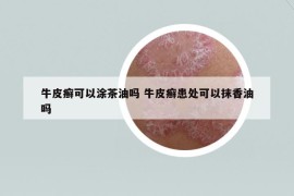 牛皮癬可以涂茶油嗎 牛皮癬患處可以抹香油嗎