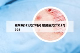 銀屑病311光療時(shí)間 銀屑病光療311與308