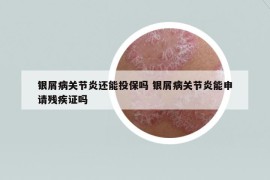 銀屑病關節(jié)炎還能投保嗎 銀屑病關節(jié)炎能申請殘疾證嗎
