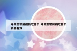 尋常型銀屑病能吃什么 尋常型銀屑病吃什么藥最有效