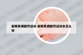 副銀屑病劇烈運動 副銀屑病劇烈運動會怎么樣