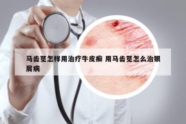 馬齒莧怎樣用治療牛皮癬 用馬齒莧怎么治銀屑病